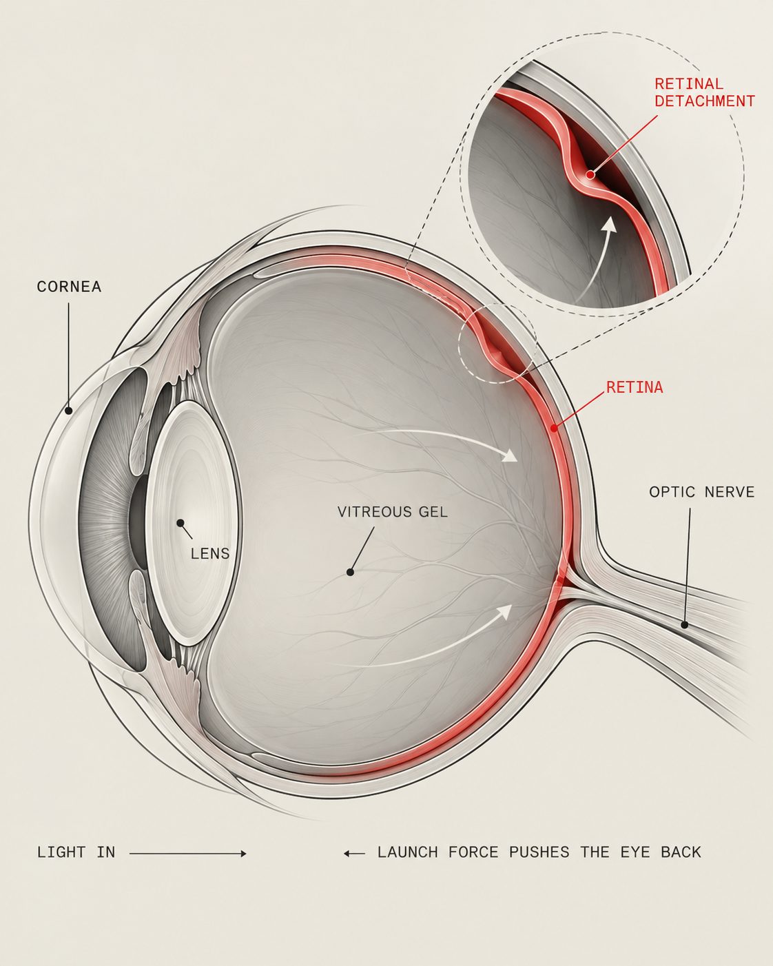 Cross-section of the eye with the cornea, lens, vitreous gel, retina and optic nerve labelled, and an inset showing the retina peeling away from the back wall